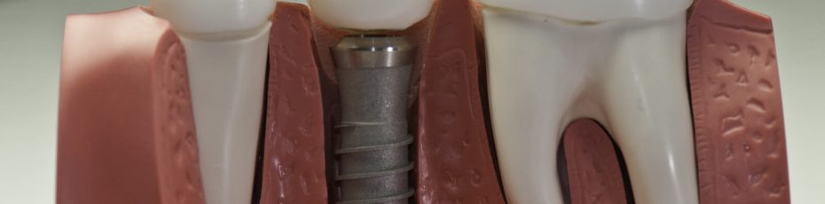 what-makes-dental-implants-the-gold-standard