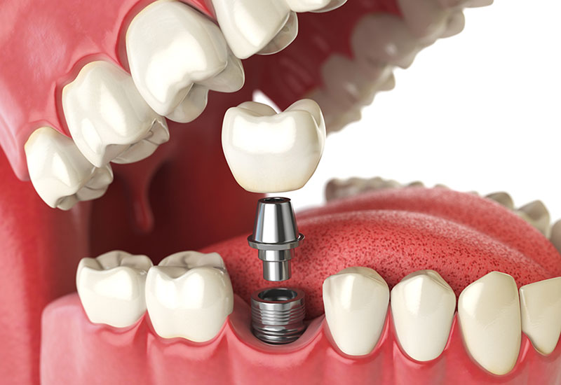 dental implants near you