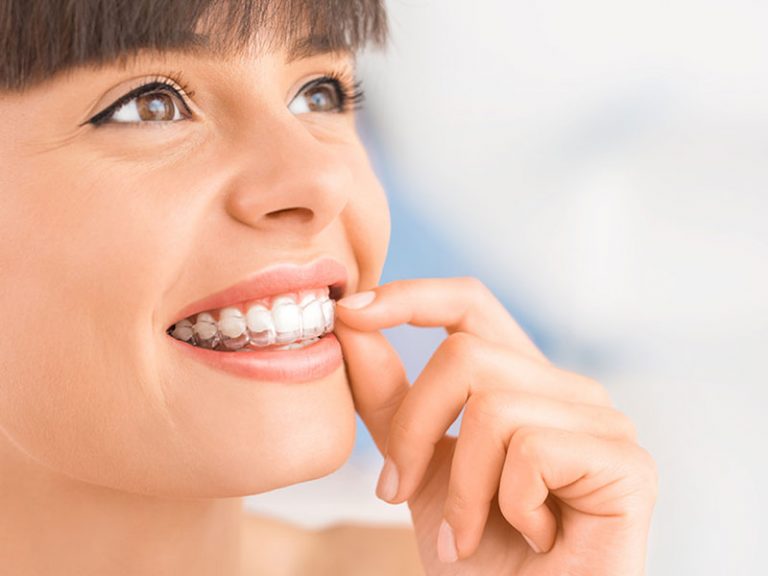 Invisalign in Grande Prairie, AB Invisalign Near You