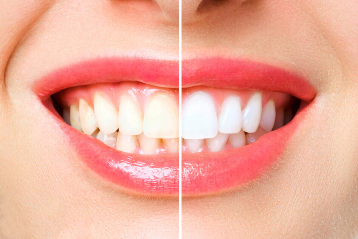 tips for brightening your smile teeth whitening