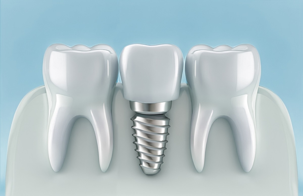 can anyone get dental implants?